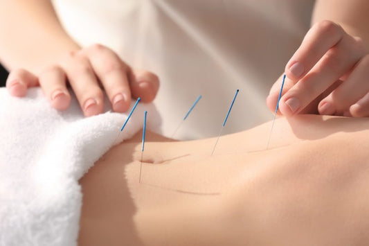 Acupuncture for IVF Support